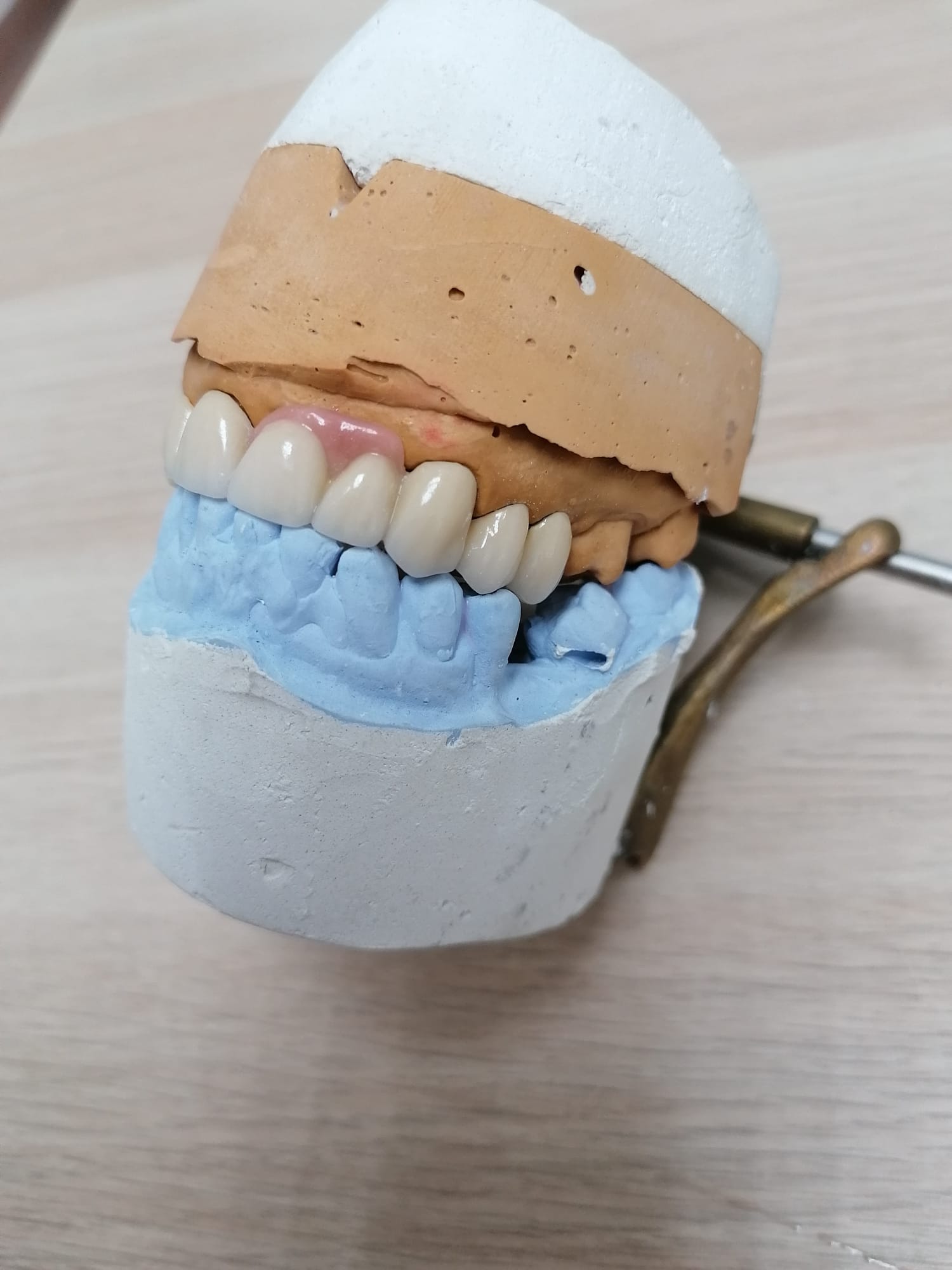 Protesis fija rehabilitacion superior metal-ceramica
